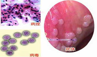 私密疣激光后几天能碰水,私密疣激光术后多久可接触水?安全恢复指南